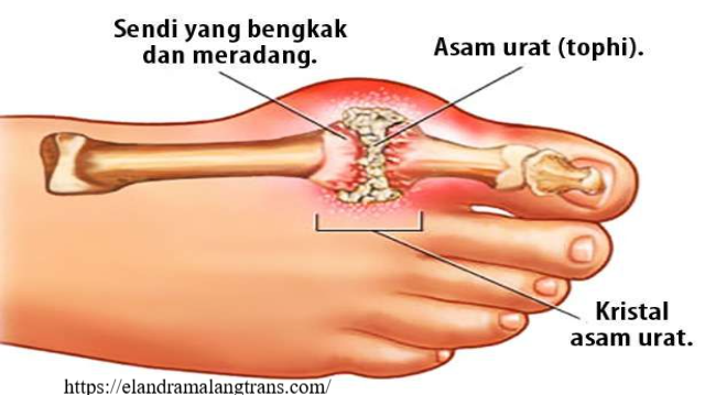 Apa Itu Asam Urat: Gejala dan Penanganannya