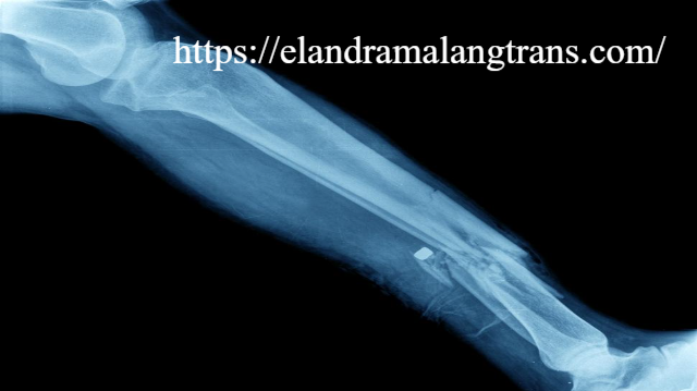 Dukun Patah Tulang vs Dokter Ortopedi